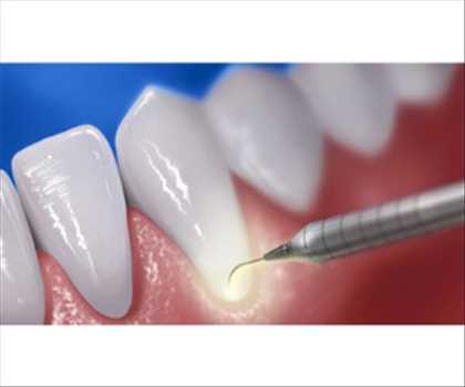 Lasers dentaires Market (New Insights Report) 2023 qui est en plein essor avec une forte croissance dans le monde jusqu’en 2030