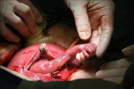 Chirurgie fœtale marché